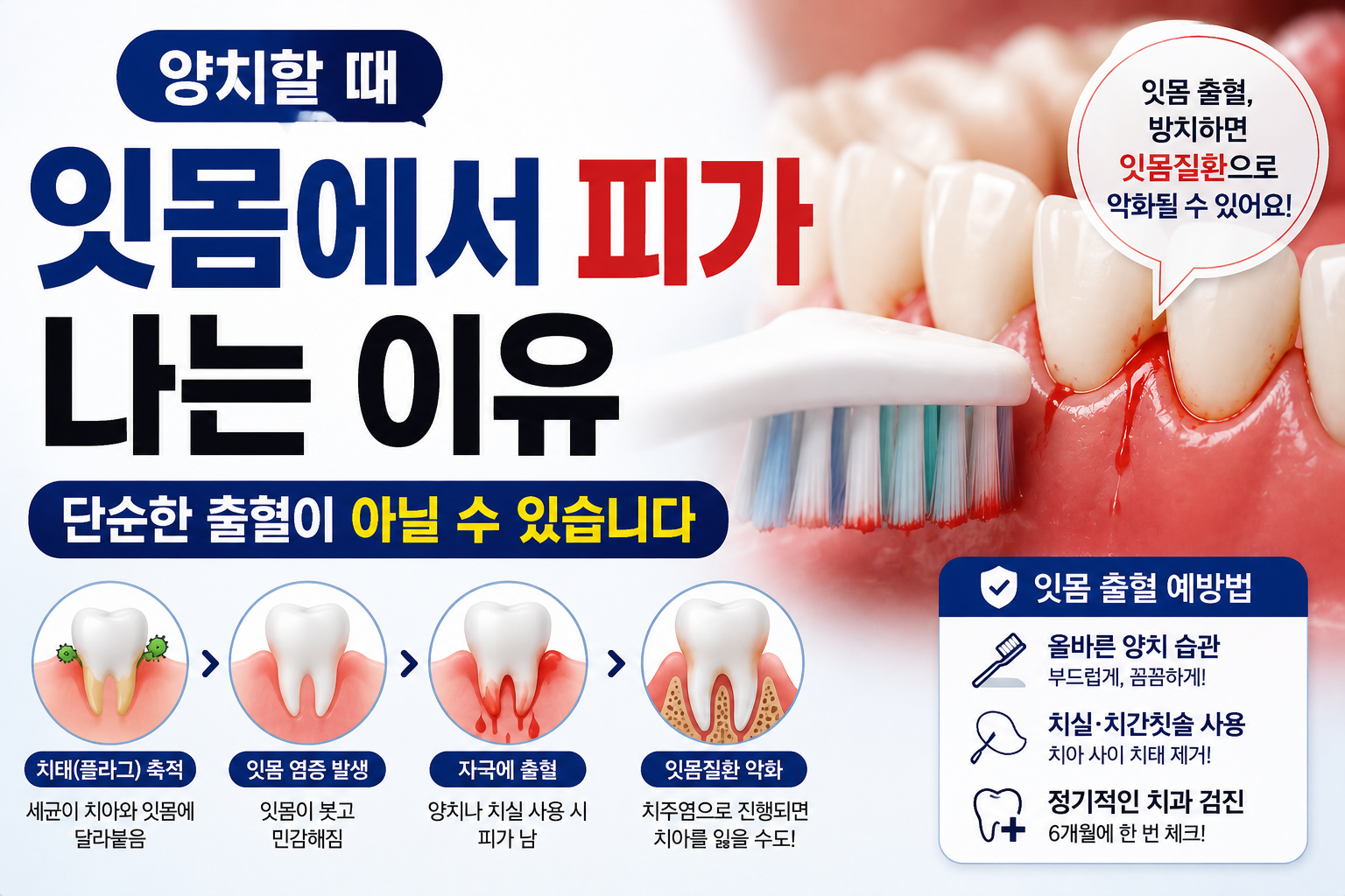 잇몸 출혈 썸네일