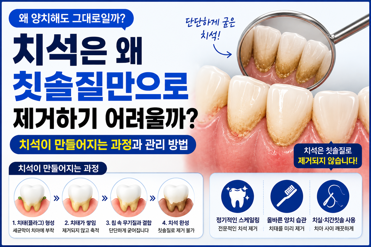 치석 썸네일