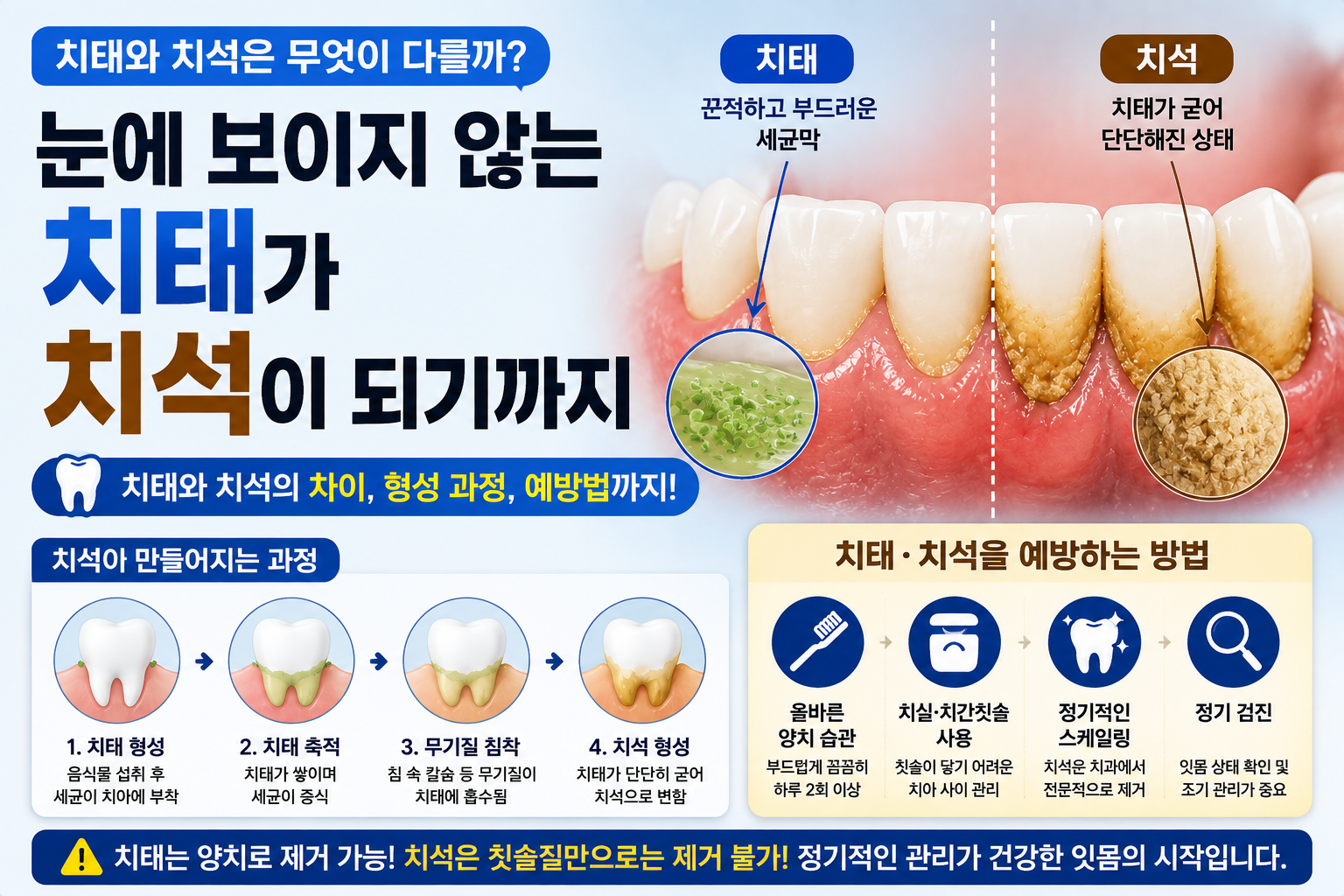 치태,치석 썸네일